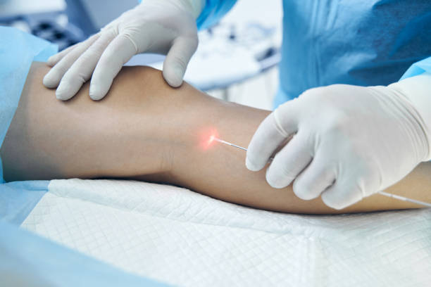 Varicose Veins